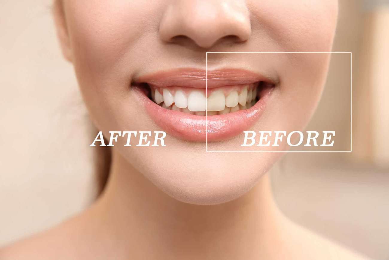 How Can You Maintain a Consistent Smile Shade with Crowns Watford?