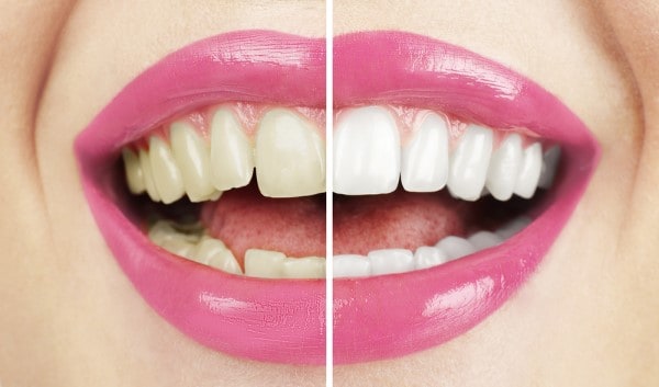 What Early Signs of Oral Cancer Should You Never Ignore Watford?