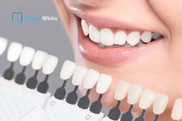 How to Maximise the Results of Your Laser Teeth Whitening Treatment Watford