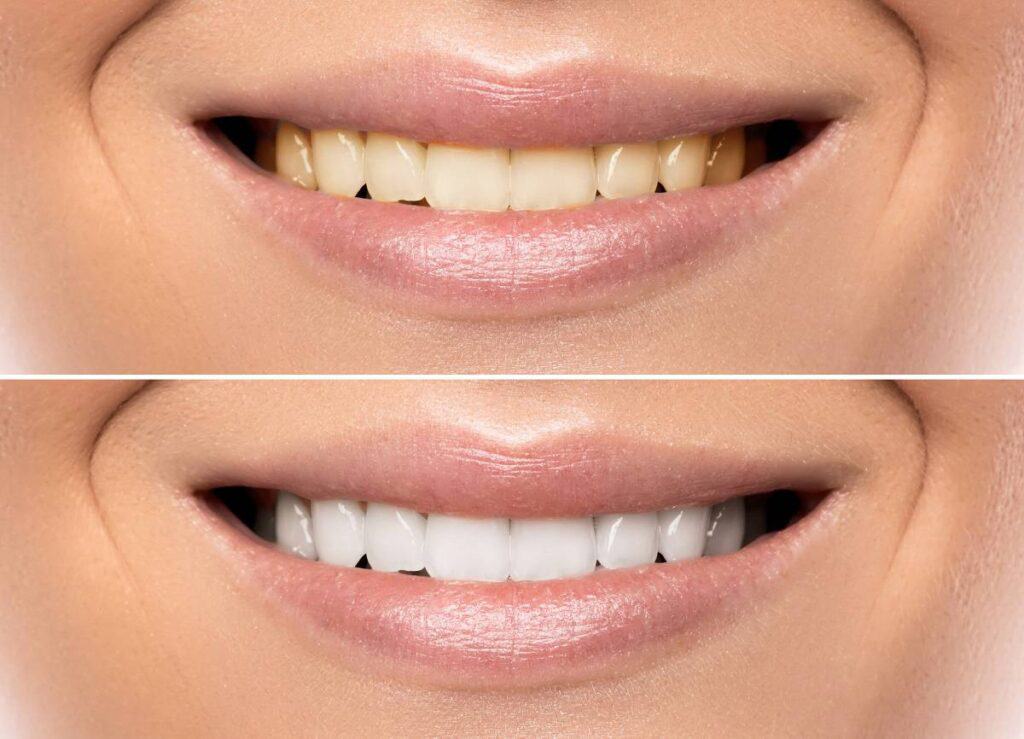 How Can You Protect Your White Smile as a Coffee Lover Watford?
