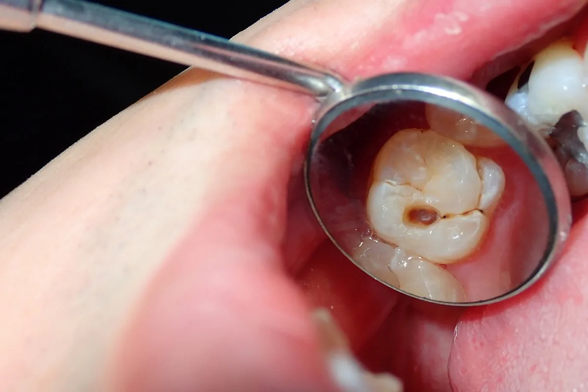 Why Do Teeth Crack? Common Causes to Know Watford