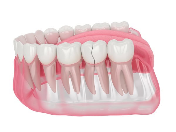 How Can You Manage Pain and Discomfort After a Root Canal Watford?