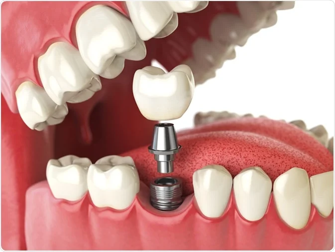 How Do I Decide Which Tooth Replacement Is Right for Me Watford?