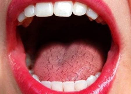 Dry Mouth and Its Role in Tooth Decay Watford