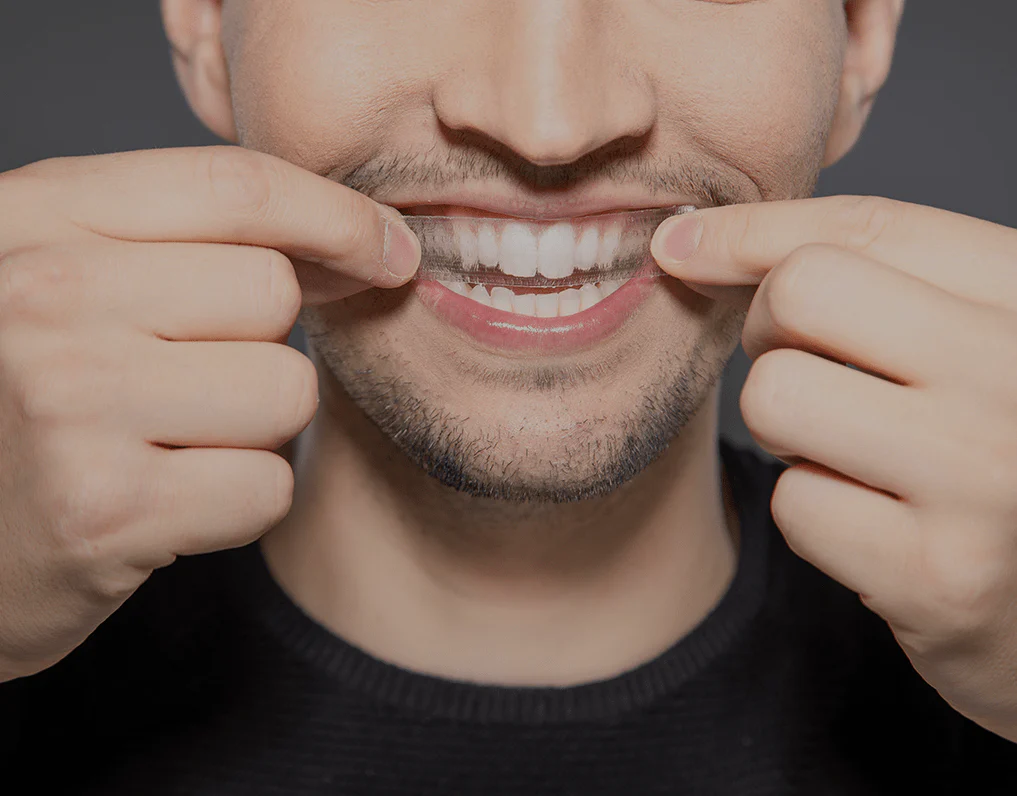 Can You Whiten Natural Teeth Without Harsh Chemicals Watford?