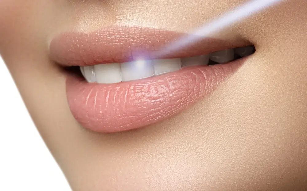 A Smarter Alternative: At-Home Laser Teeth Whitening Watford
