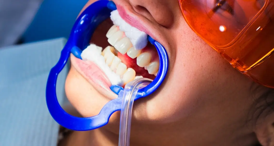 What Side Effects Can You Experience After Laser Teeth Whitening Watford?