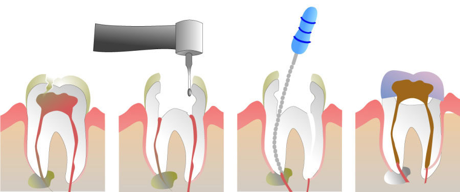 How Do You Properly Care for Your Teeth After a Root Canal Watford