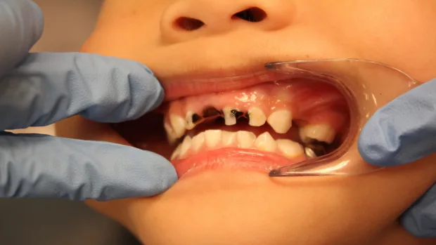 Which Foods and Drinks Cause the Most Damage to Young Smiles Watford?