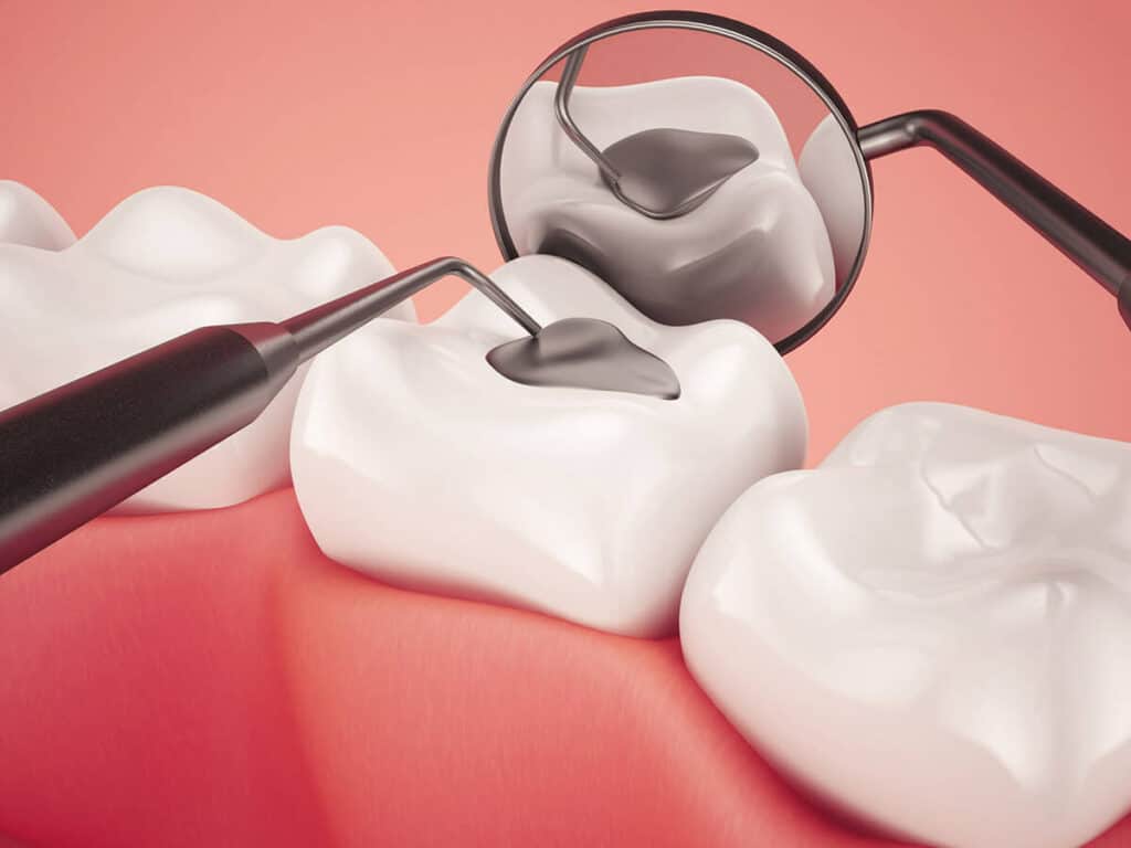 Fighting Cavities and Plaque Buildup Watford