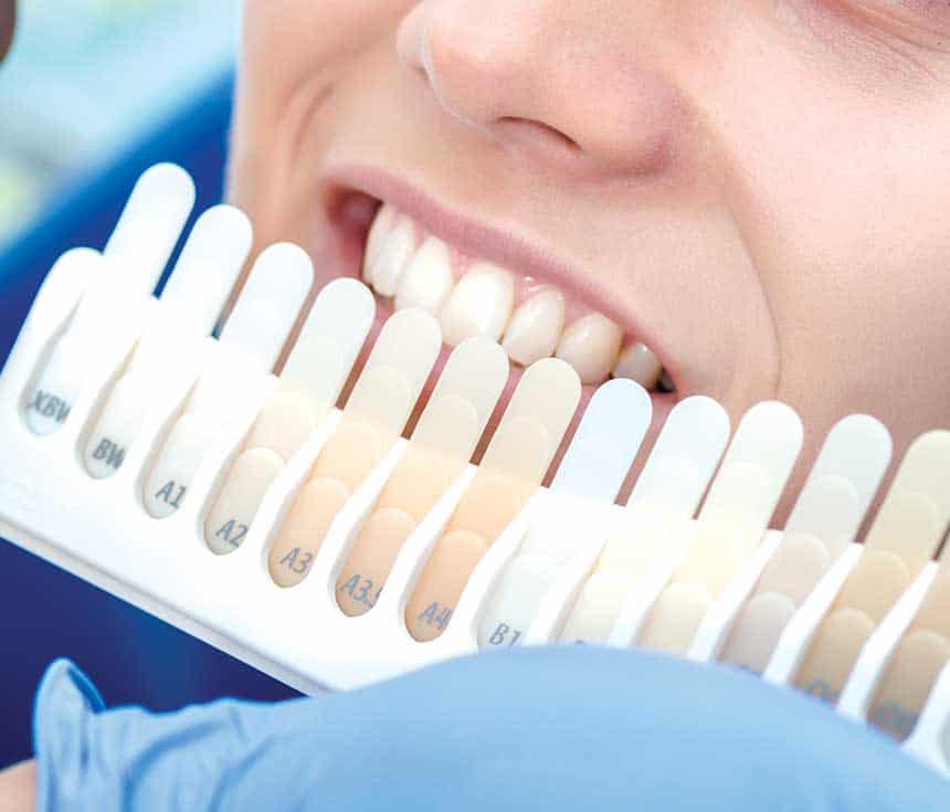 Professional vs At-Home Whitening: What You Need to Know Watford