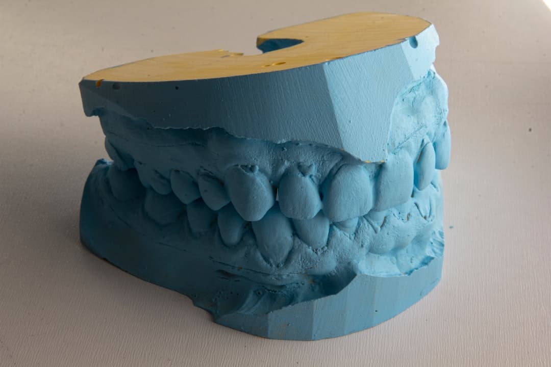 How Do Dental Implants Improve Jawbone Health and Oral Function Watford?