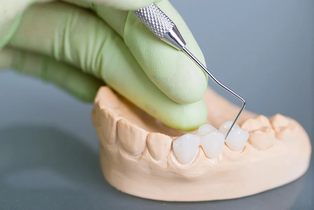 What Are the Different Types of Dental Crowns Available Watford?