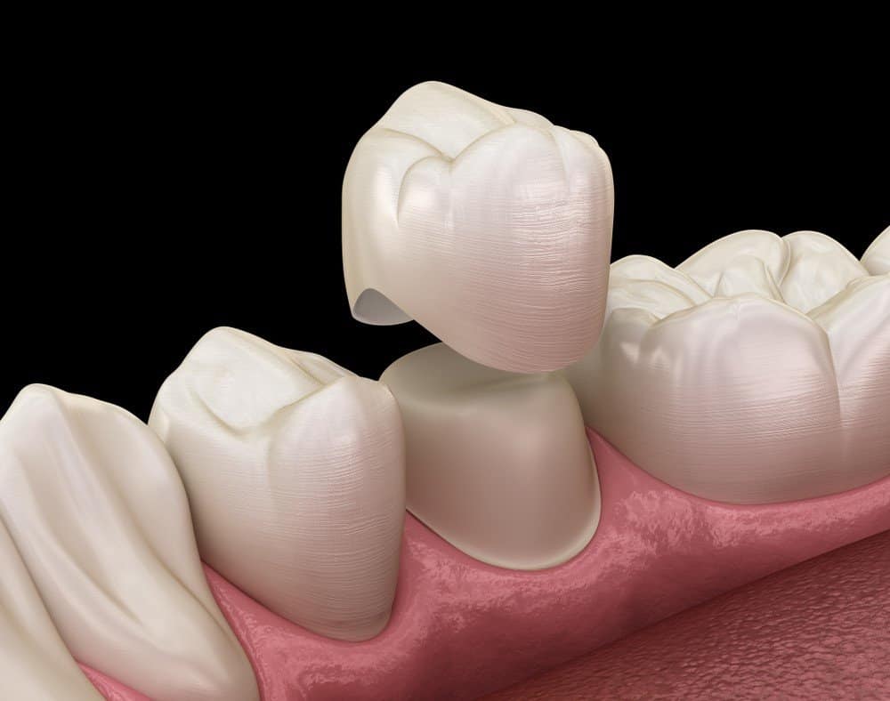 Teeth Whitening: Separating Facts from Fiction Watford