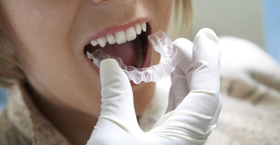 Why Bleaching Trays Require More Time Watford