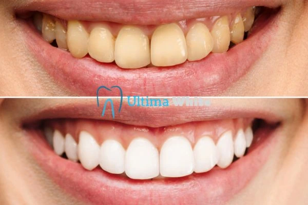 Oral Care Tips for Current and Former Smokers Watford