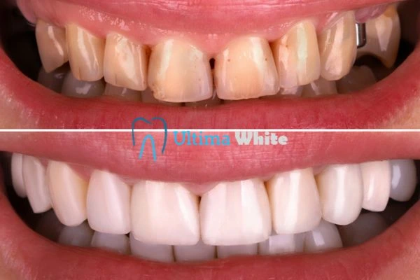 What Makes Instant Teeth Whitening Treatments So Popular Watford?