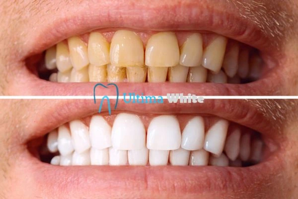 Stained Teeth and Persistent Bad Breath Watford